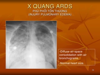 58
X QUANG ARDS
PHUØ PHOÅI TOÅN THÖÔNG
(INJURY PULMONARY EDEMA)
-Diffuse air-space
consolidation with air
bronchograms.
-Normal heart size.
 