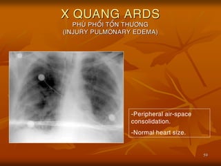 59
X QUANG ARDS
PHUØ PHOÅI TOÅN THÖÔNG
(INJURY PULMONARY EDEMA)
-Peripheral air-space
consolidation.
-Normal heart size.
 