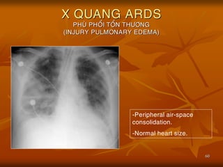 60
X QUANG ARDS
PHUØ PHOÅI TOÅN THÖÔNG
(INJURY PULMONARY EDEMA)
-Peripheral air-space
consolidation.
-Normal heart size.
 