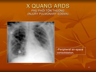 61
X QUANG ARDS
PHUØ PHOÅI TOÅN THÖÔNG
(INJURY PULMONARY EDEMA)
-Peripheral air-space
consolidation.
 
