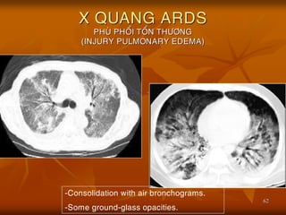 62
X QUANG ARDS
PHUØ PHOÅI TOÅN THÖÔNG
(INJURY PULMONARY EDEMA)
-Consolidation with air bronchograms.
-Some ground-glass opacities.
 
