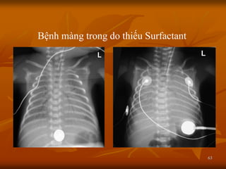 63
Bệnh màng trong do thiếu Surfactant
 