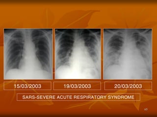 65
SARS-SEVERE ACUTE RESPIRATORY SYNDROME
15/03/2003 19/03/2003 20/03/2003
 