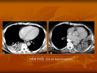 8
VIEÂM PHOÅI (Coù air bronchogram)
 
