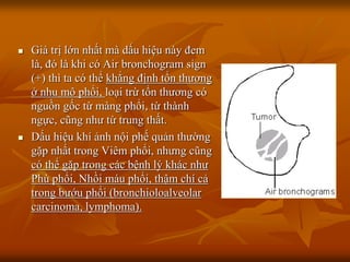  Giá trị lớn nhất mà dấu hiệu này đem
là, đó là khi có Air bronchogram sign
(+) thì ta có thể khẳng định tổn thƣơng
ở nhu mô phổi, loại trừ tổn thƣơng có
nguồn gốc từ màng phổi, từ thành
ngực, cũng nhƣ từ trung thất.
 Dấu hiệu khí ảnh nội phế quản thƣờng
gặp nhất trong Viêm phổi, nhƣng cũng
có thể gặp trong các bệnh lý khác nhƣ
Phù phổi, Nhồi máu phổi, thậm chí cả
trong bƣớu phổi (bronchioloalveolar
carcinoma, lymphoma).
 