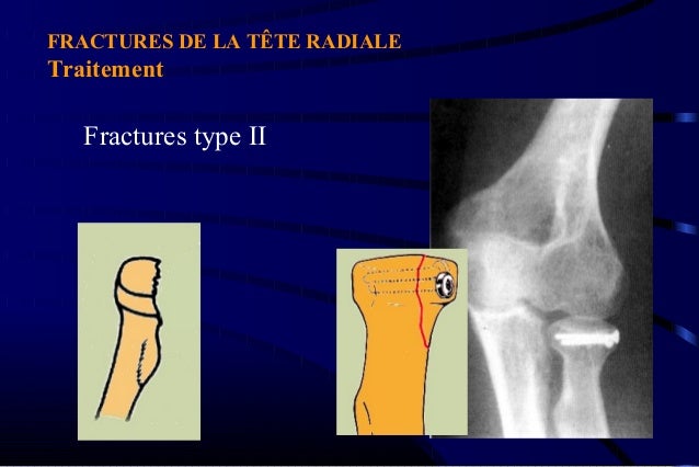 Protocol Fracture De La Teta _ Fracture Tete Radiale Coude Rééducation ...