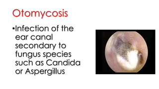 Otomycosis
•Infection of the
ear canal
secondary to
fungus species
such as Candida
or Aspergillus
 