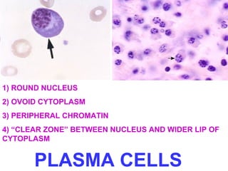 1) ROUND NUCLEUS 
2) OVOID CYTOPLASM 
3) PERIPHERAL CHROMATIN 
4) “CLEAR ZONE” BETWEEN NUCLEUS AND WIDER LIP OF 
CYTOPLASM 
PLASMA CELLS 
 