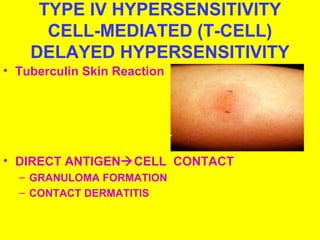 TYPE IV HYPERSENSITIVITY 
CELL-MEDIATED (T-CELL) 
DELAYED HYPERSENSITIVITY 
• Tuberculin Skin Reaction 
• DIRECT ANTIGENCELL CONTACT 
– GRANULOMA FORMATION 
– CONTACT DERMATITIS 
 