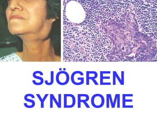 SJÖGREN 
SYNDROME 
 