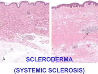 SCLERODERMA 
(SYSTEMIC SCLEROSIS) 
 