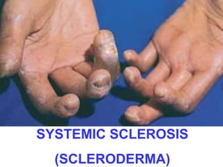 SYSTEMIC SCLEROSIS 
(SCLERODERMA) 
 