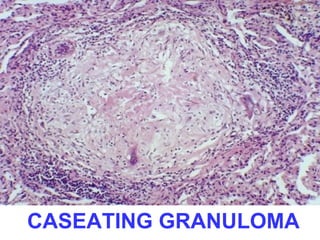 CASEATING GRANULOMA 
 