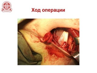 Хирургическое лечение разрывов сухожилия большой грудной мышцы