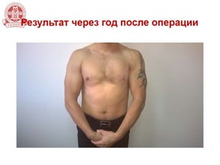 Хирургическое лечение разрывов сухожилия большой грудной мышцы