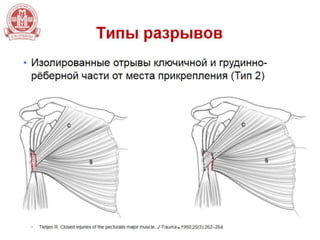 Хирургическое лечение разрывов сухожилия большой грудной мышцы
