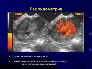 Рак эндометрия 
• Слева – типичная эхоструктура РЭ 
• Справа - множественные, хаотичные цветовые локусы 
(энергетическая допплерография) 
 