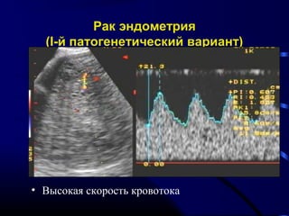 Рак эндометрия 
(I-й патогенетический вариант) 
• Высокая скорость кровотока 
 