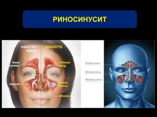 РИНОСИНУСИТ 
 