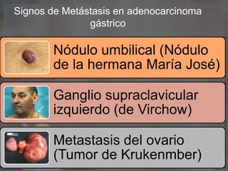 Signos de Metástasis en adenocarcinoma
gástrico
Nódulo umbilical (Nódulo
de la hermana María José)
Ganglio supraclavicular
izquierdo (de Virchow)
Metastasis del ovario
(Tumor de Krukenmber)
 