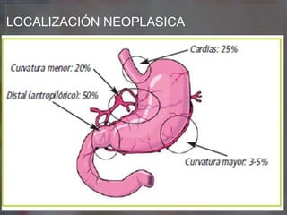 LOCALIZACIÓN NEOPLASICA
 