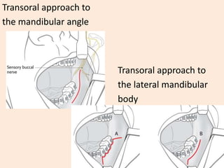 Transoral approach to
the mandibular angle
Transoral approach to
the lateral mandibular
body
 