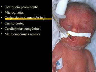 • Occipucio prominente.
• Micrognatia.
• Orejas de implantación baja.
• Cuello corto.
• Cardiopatías congénitas.
• Malformaciones renales
 
