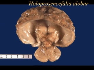 Holoprosencefalia alobar
 