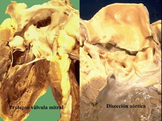 Prolapso válvula mitral Disección aórtica
 