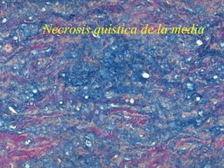 Necrosis quística de la media
 
