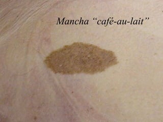 Mancha “café-au-lait”
 