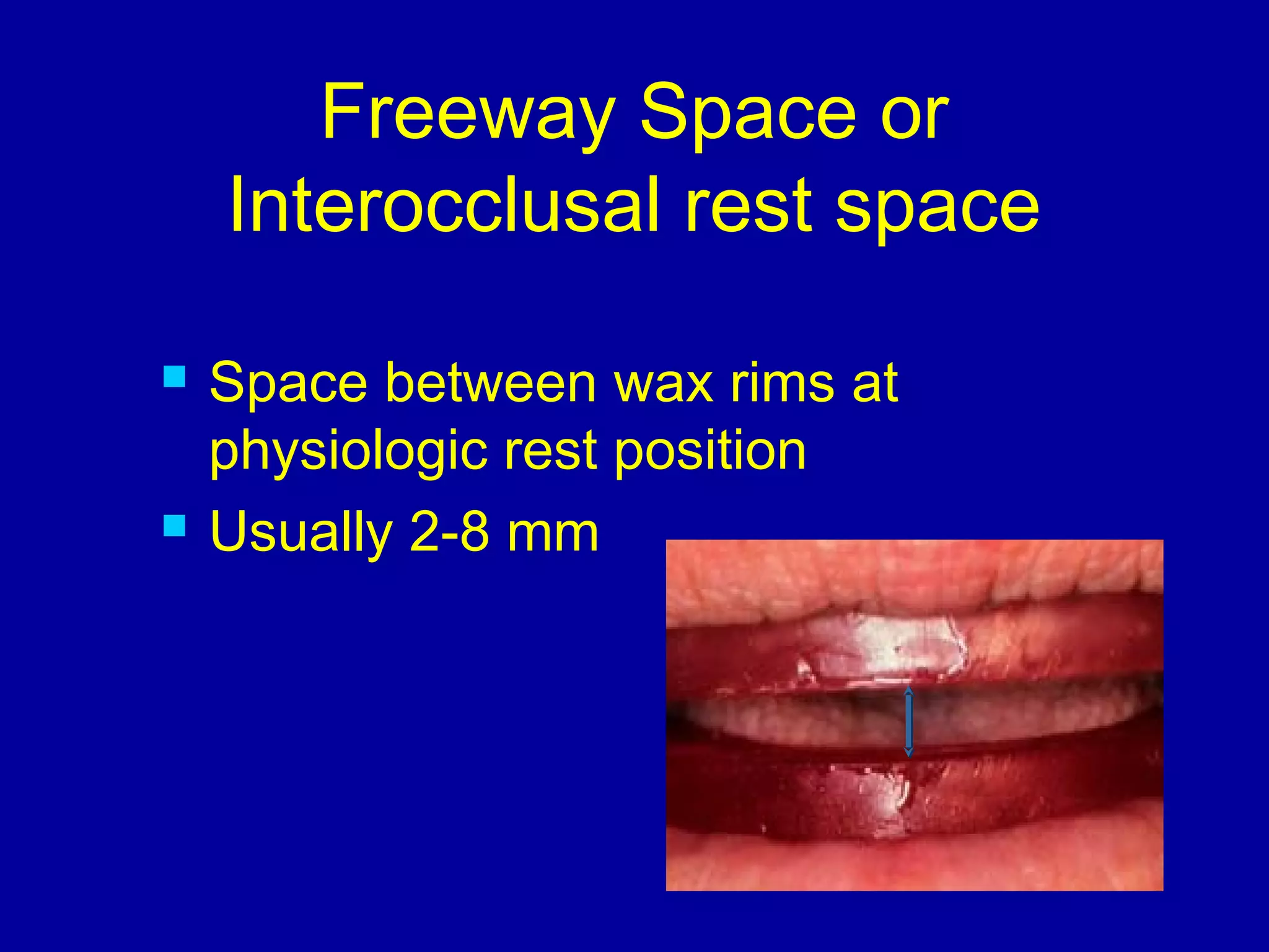 Freeway Space or
Interocclusal rest space
 Space between wax rims at
physiologic rest position
 Usually 2-8 mm
 