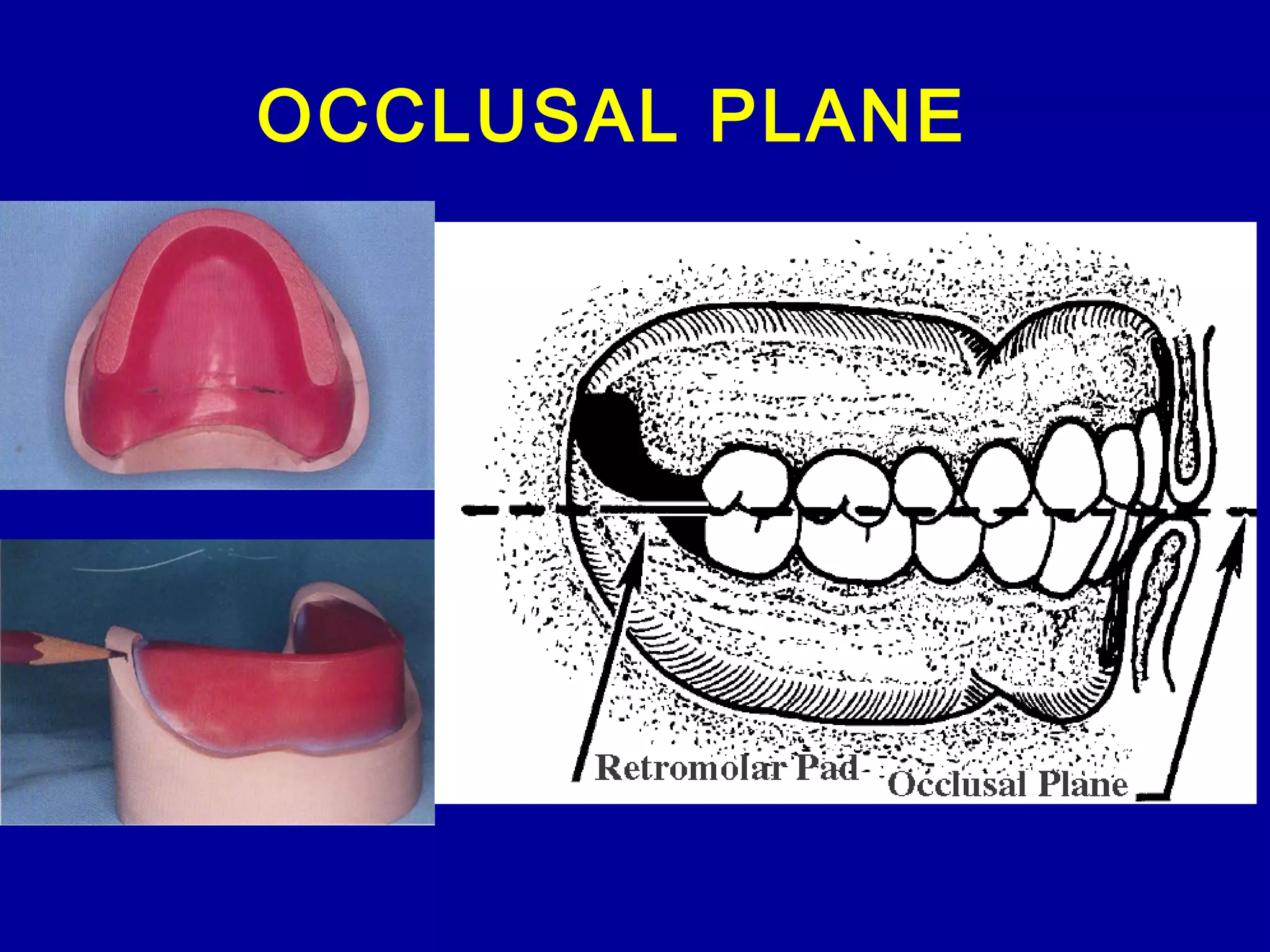OCCLUSAL PLANE
 