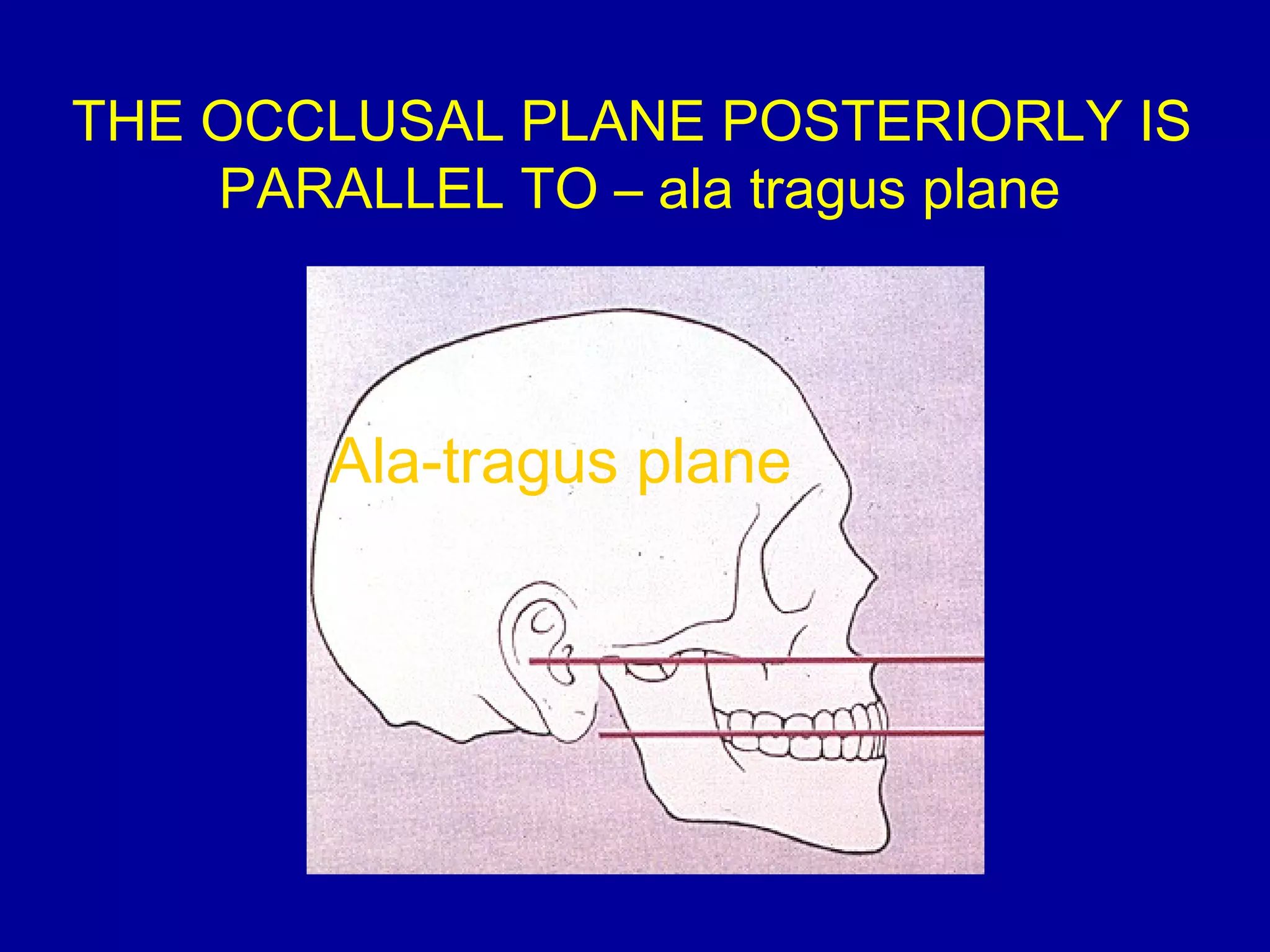 THE OCCLUSAL PLANE POSTERIORLY IS
PARALLEL TO – ala tragus plane
Ala-tragus plane
 