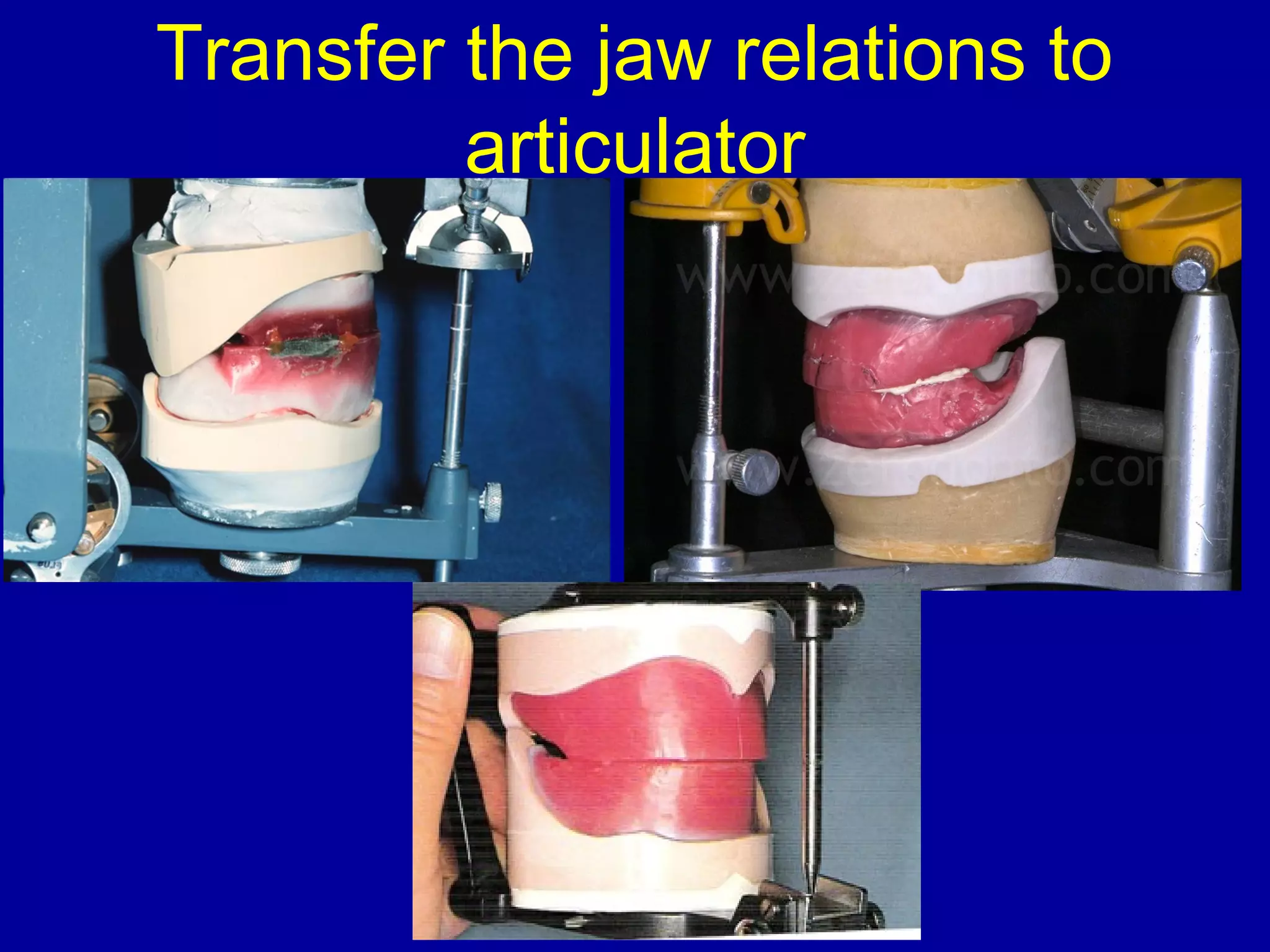 Transfer the jaw relations to
articulator
 