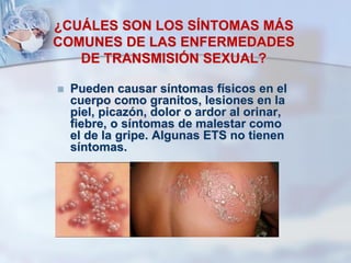 ¿CUÁLES SON LOS SÍNTOMAS MÁS
COMUNES DE LAS ENFERMEDADES
DE TRANSMISIÓN SEXUAL?
 Pueden causar síntomas físicos en el
cuerpo como granitos, lesiones en la
piel, picazón, dolor o ardor al orinar,
fiebre, o síntomas de malestar como
el de la gripe. Algunas ETS no tienen
síntomas.
 
