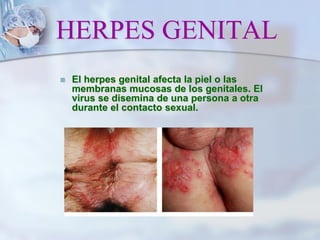 HERPES GENITAL
 El herpes genital afecta la piel o las
membranas mucosas de los genitales. El
virus se disemina de una persona a otra
durante el contacto sexual.
 