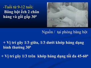 -Tuổi từ 9-12 tuổi:
Băng bột ếch 2 chân
háng và gối gấp 300
Nguồn / tại phòng băng bột
+ Vị trí gãy 1/3 giữa, 1/3 dưới khớp háng dạng
bình thường 300
+ Vị trí gãy 1/3 trên khớp háng dạng tối đa 45-600
 