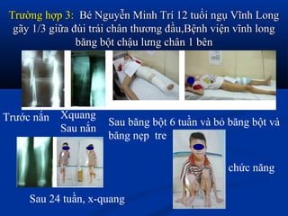 Trường hợp 3:Trường hợp 3: Bé Nguyễn Minh Trí 12 tuổi ngụ Vĩnh LongBé Nguyễn Minh Trí 12 tuổi ngụ Vĩnh Long
gãy 1/3 giữa đùi trái chân thương đầu,Bệnh viện vĩnh longgãy 1/3 giữa đùi trái chân thương đầu,Bệnh viện vĩnh long
băng bột chậu lưng chân 1 bênbăng bột chậu lưng chân 1 bên
Trước nắn Xquang
Sau nắn
Sau băng bột 6 tuần và bỏ băng bột và
băng nẹp tre
Sau 24 tuần, x-quang
chức năng
 