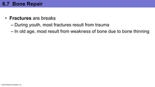 6.7 Bone Repair
• Fractures are breaks
– During youth, most fractures result from trauma
– In old age, most result from weakness of bone due to bone thinning
© 2016 Pearson Education, Inc.
 