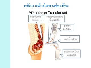 PD catheter Transfer set
หลักการล้างไตทางช่องท้อง
 