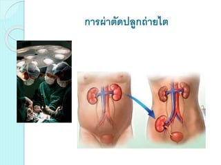 การผ่าตัดปลูกถ่ายไต
 