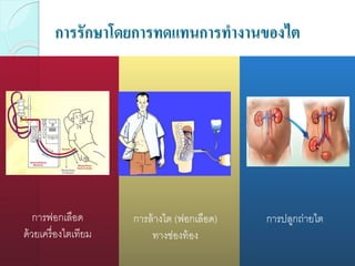 การรักษาโดยการทดแทนการทางานของไต
การฟอกเลือด
ด้วยเครื่องไตเทียม
การล้างไต (ฟอกเลือด)
ทางช่องท้อง
การปลูกถ่ายไต
 
