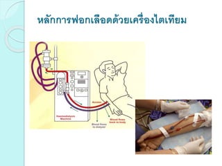 หลักการฟอกเลือดด้วยเครื่องไตเทียม
 