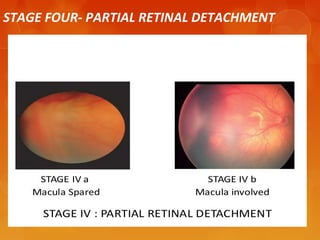 RETINOPATHY OF PREMATURITY | PPT