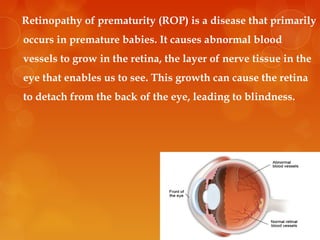 RETINOPATHY OF PREMATURITY | PPT