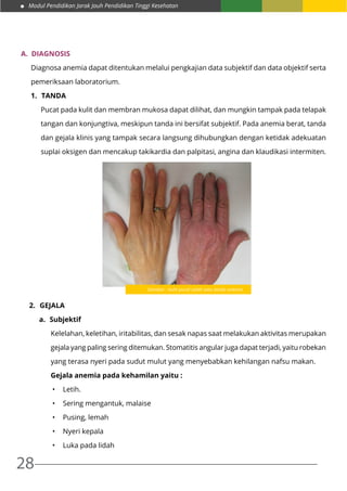 Modul Pendidikan Jarak Jauh Pendidikan Tinggi Kesehatan
28
A.	 Diagnosis
Diagnosa anemia dapat ditentukan melalui pengkajian data subjektif dan data objektif serta
pemeriksaan laboratorium.
1.	 Tanda
Pucat pada kulit dan membran mukosa dapat dilihat, dan mungkin tampak pada telapak
tangan dan konjungtiva, meskipun tanda ini bersifat subjektif. Pada anemia berat, tanda
dan gejala klinis yang tampak secara langsung dihubungkan dengan ketidak adekuatan
suplai oksigen dan mencakup takikardia dan palpitasi, angina dan klaudikasi intermiten.
2.	 Gejala
a.	 Subjektif
Kelelahan, keletihan, iritabilitas, dan sesak napas saat melakukan aktivitas merupakan
gejala yang paling sering ditemukan. Stomatitis angular juga dapat terjadi, yaitu robekan
yang terasa nyeri pada sudut mulut yang menyebabkan kehilangan nafsu makan.
Gejala anemia pada kehamilan yaitu :
•	 Letih.
•	 Sering mengantuk, malaise
•	 Pusing, lemah
•	 Nyeri kepala
•	 Luka pada lidah
Gambar : Kulit pucat salah satu tanda anemia
 