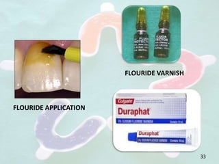 FLOURIDE APPLICATION
FLOURIDE VARNISH
33
 
