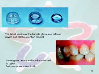 62
The latest version of the fluoride glass slow release
device and plastic retention bracket
Latest glass device and bracket attached
to upper
first permanent molar tooth
 