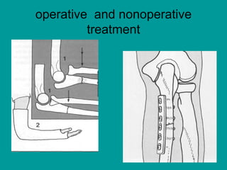 Fracture of Forearm Bones | PPT